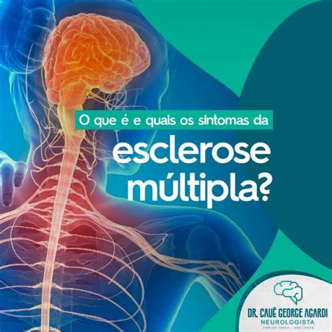 o que causa a esclerose multipla|ESCLEROSE MÚLTIPLA .